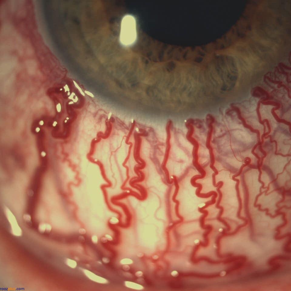 وضعیت مویرگ‌های چشم انسان پس از گریه! +عکس