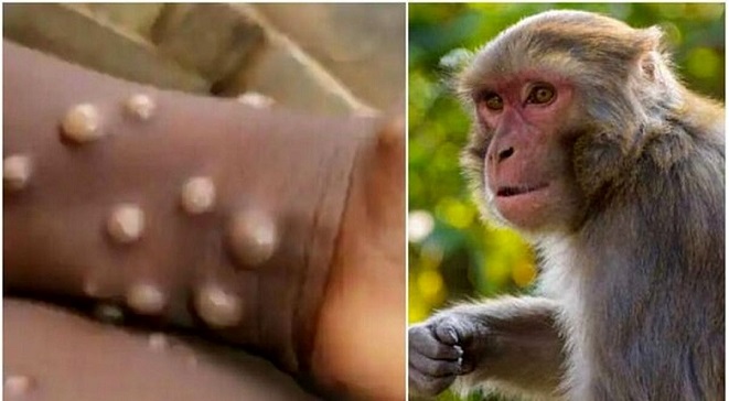 اقدامات وزارت بهداشت برای مقابله با آبله میمونی